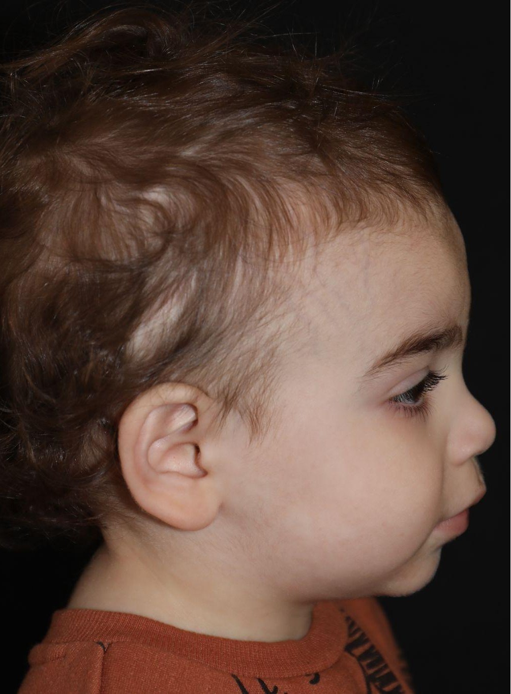Right profile at Year 4 after treatment - Case 1016
