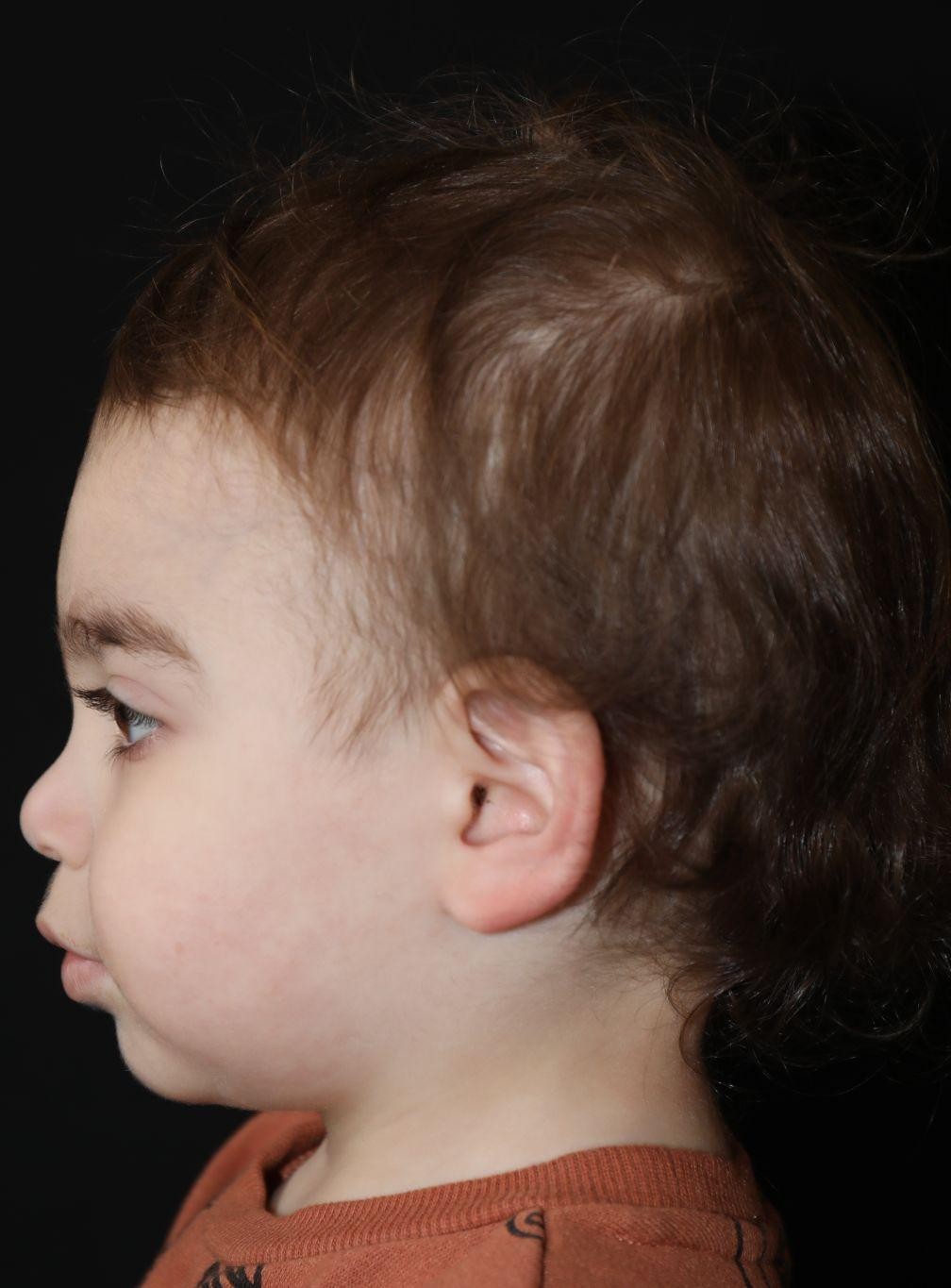 Left profile at Year 4 after treatment - Case 1016