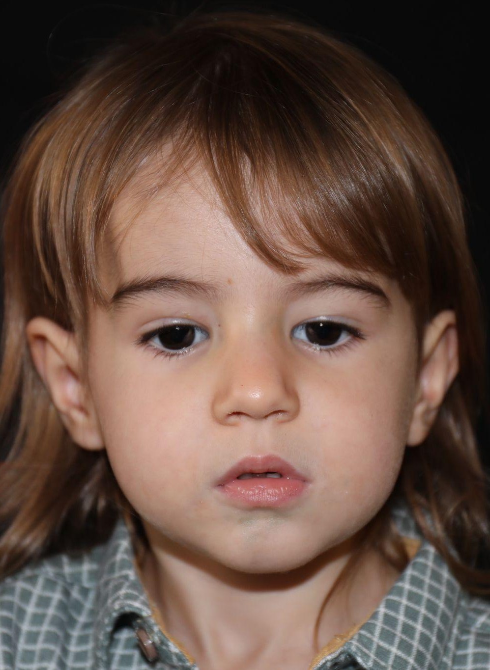 Front view at Year 5 after treatment - Case 5002