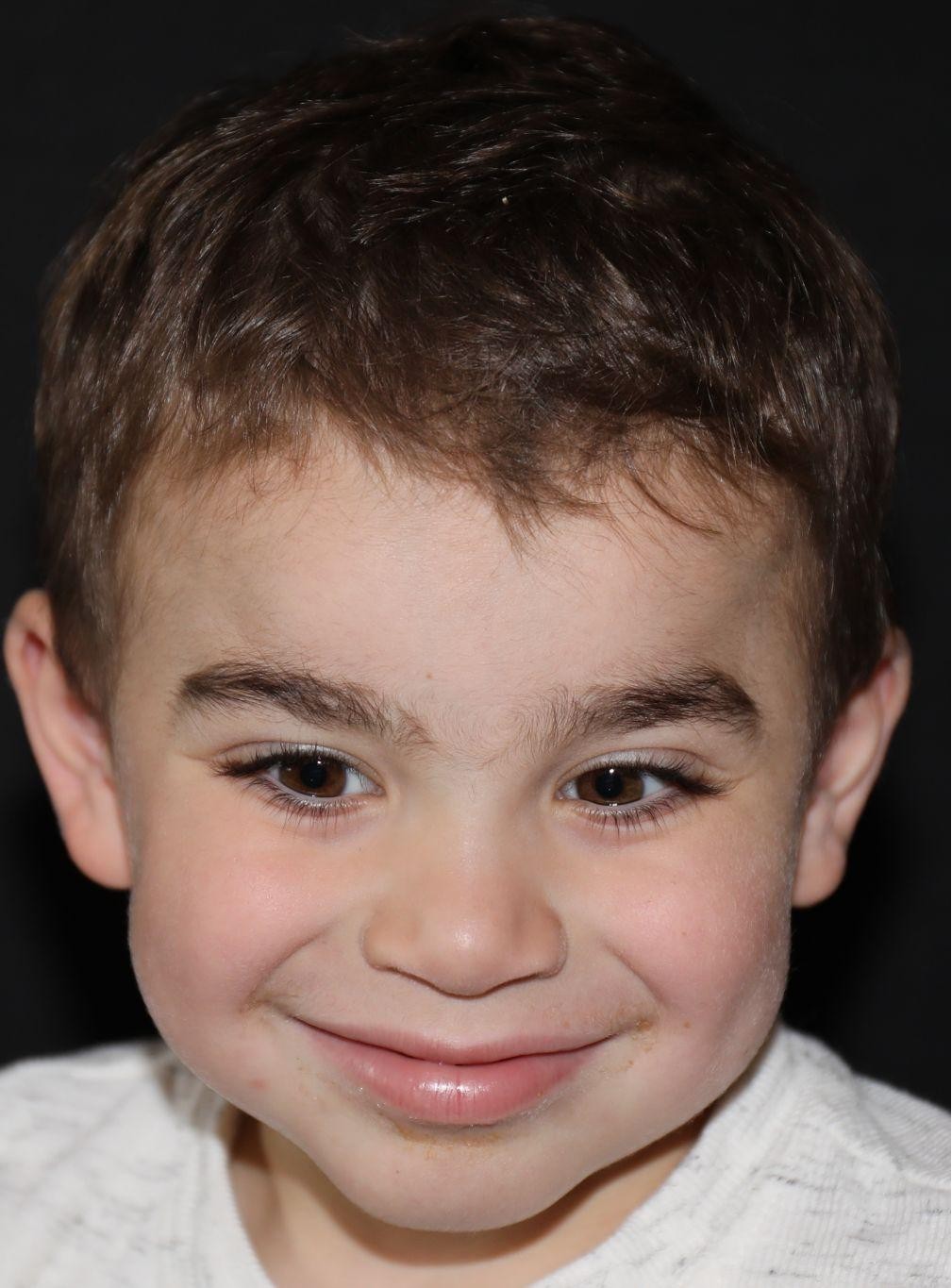 Front view at Year 5 after treatment - Case 1016