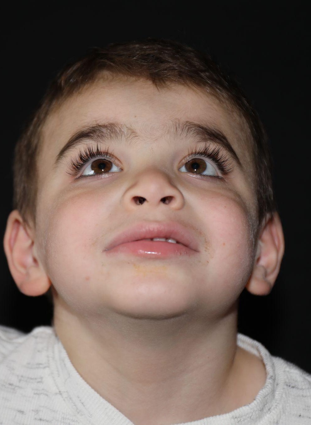 Chin at Year 5 after treatment - Case 1016