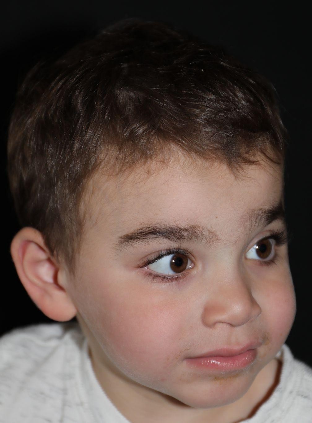 Right angle at Year 5 after treatment - Case 1016
