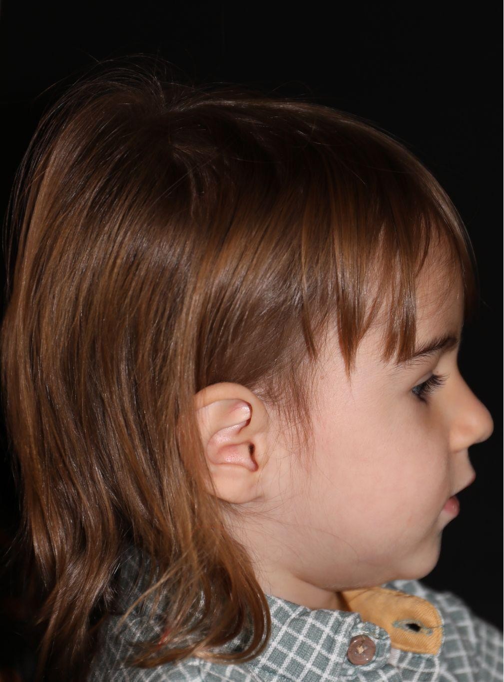 Right profile at Year 5 after treatment - Case 5002