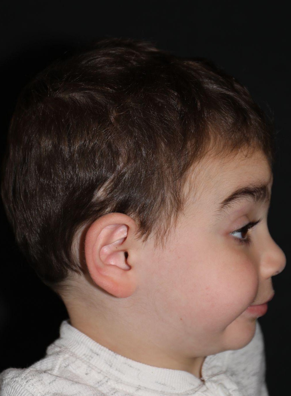 Right profile at Year 5 after treatment - Case 1016