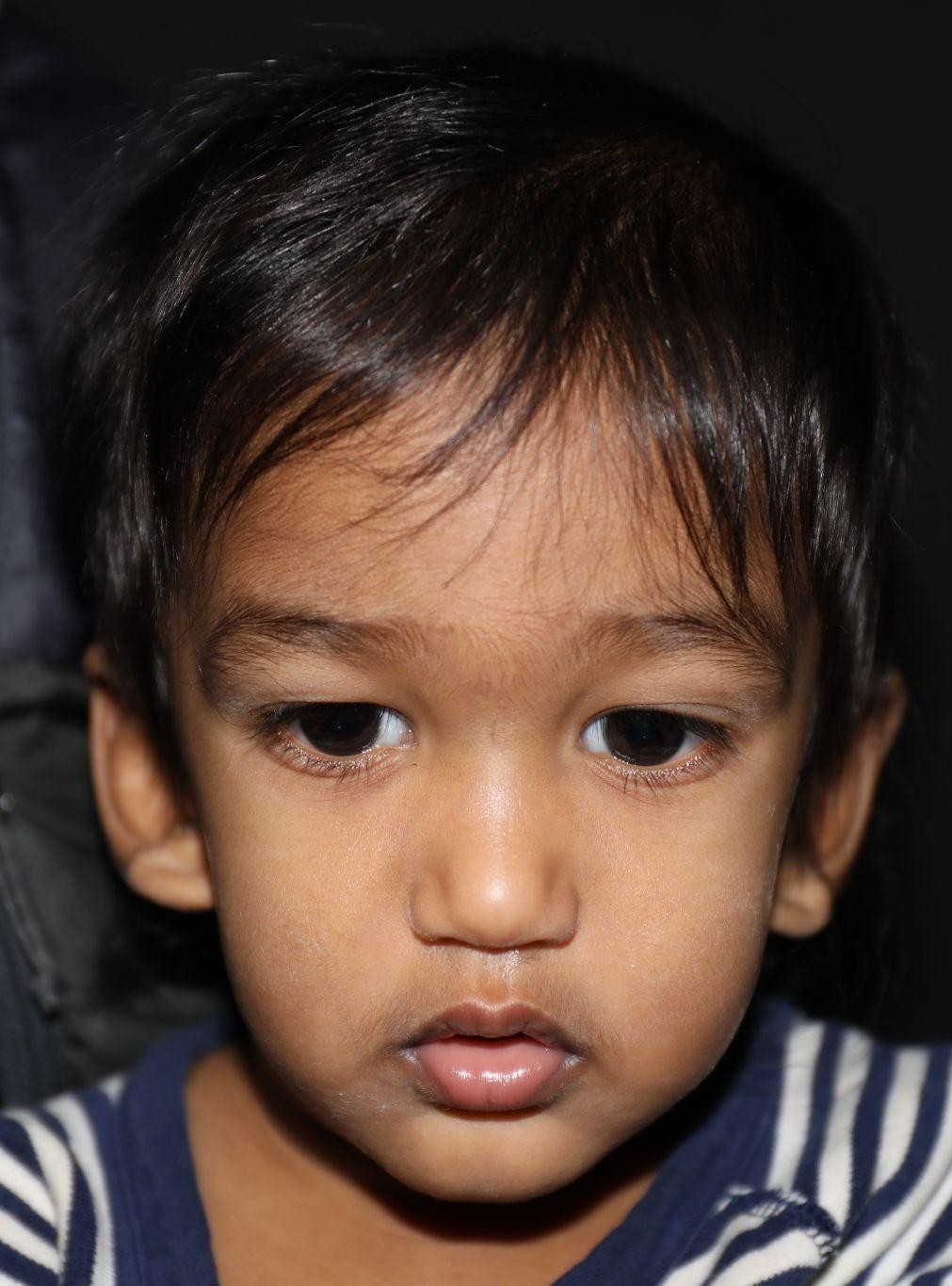 Front view before treatment - Case 1011