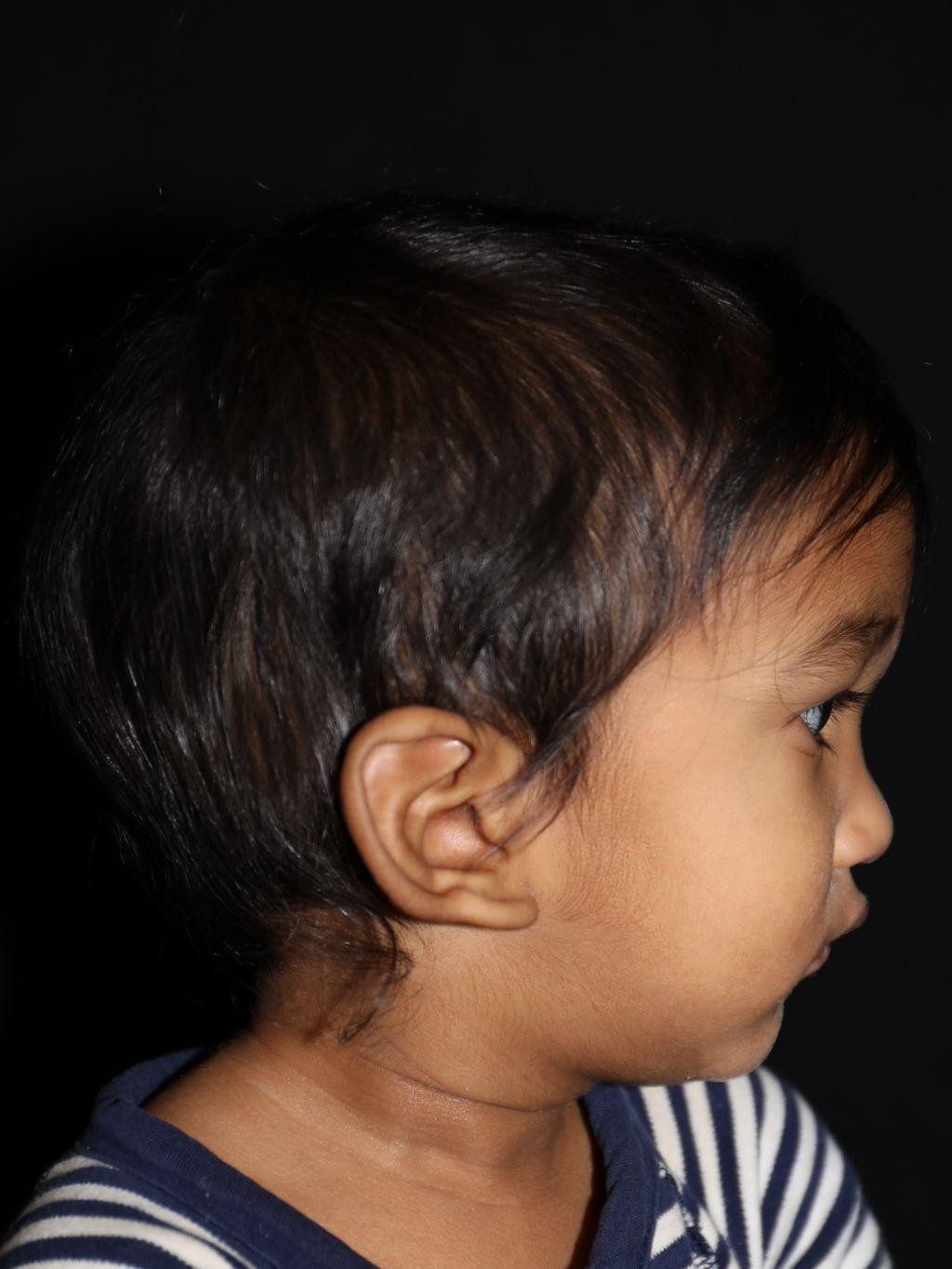 Right profile before treatment - Case 1011
