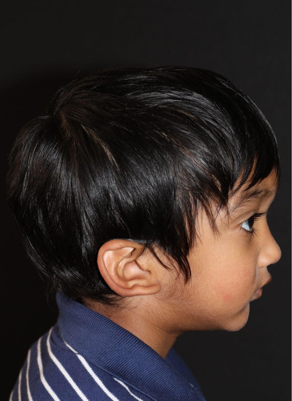 Right profile at Year 2 after treatment - Case 1011