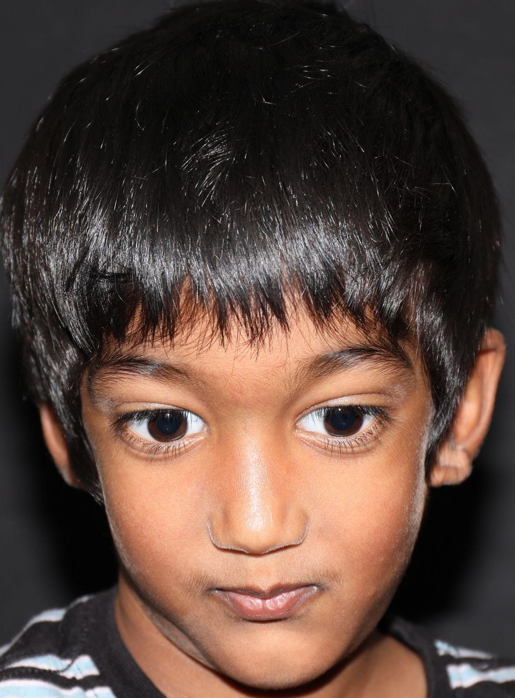 Front view at Year 3 after treatment - Case 1011