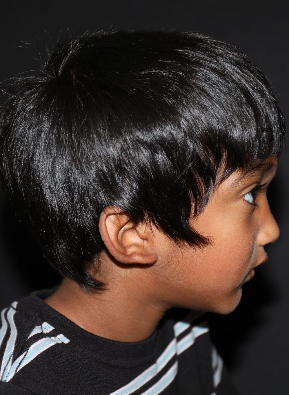 Right profile at Year 3 after treatment - Case 1011