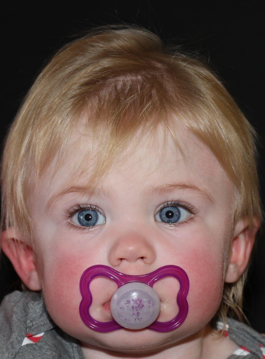 Front view at Year 3 after treatment - Case 1012