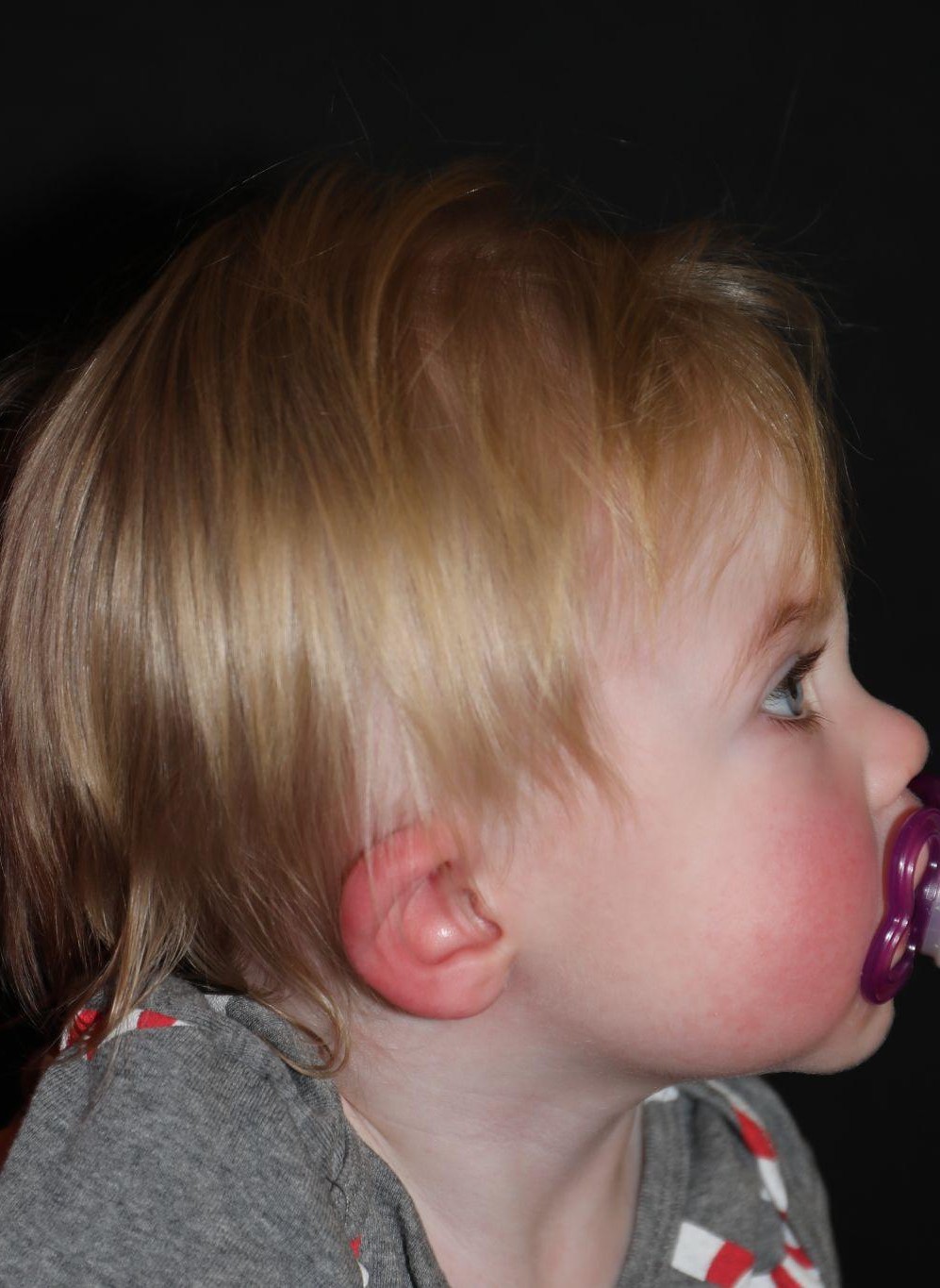 Right profile before treatment - Case 1012