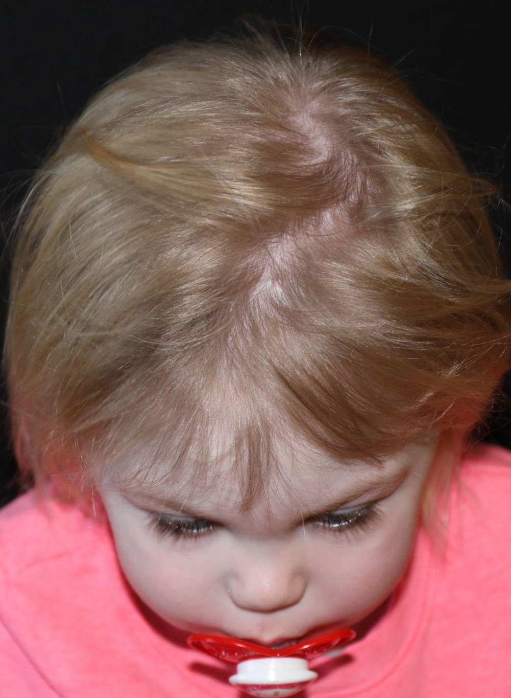 Top (vertex) at Year 4 after treatment - Case 1012