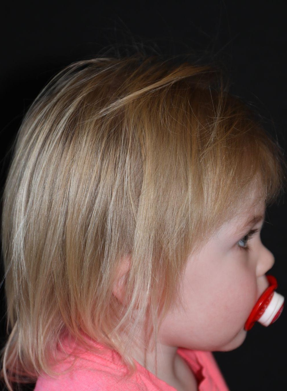 Right profile at Year 4 after treatment - Case 1012